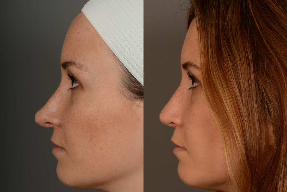 top rhinoplasty surgeons