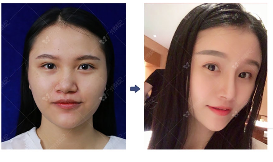 top rhinoplasty surgeons –  What do my cosmetic surgery patients want? To look better in selfies.