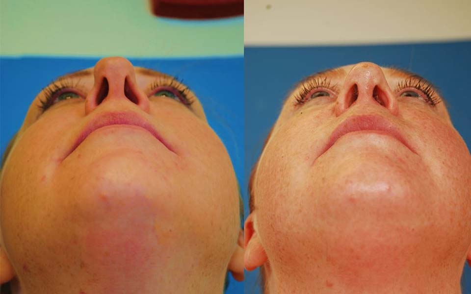 top rhinoplasty surgeons