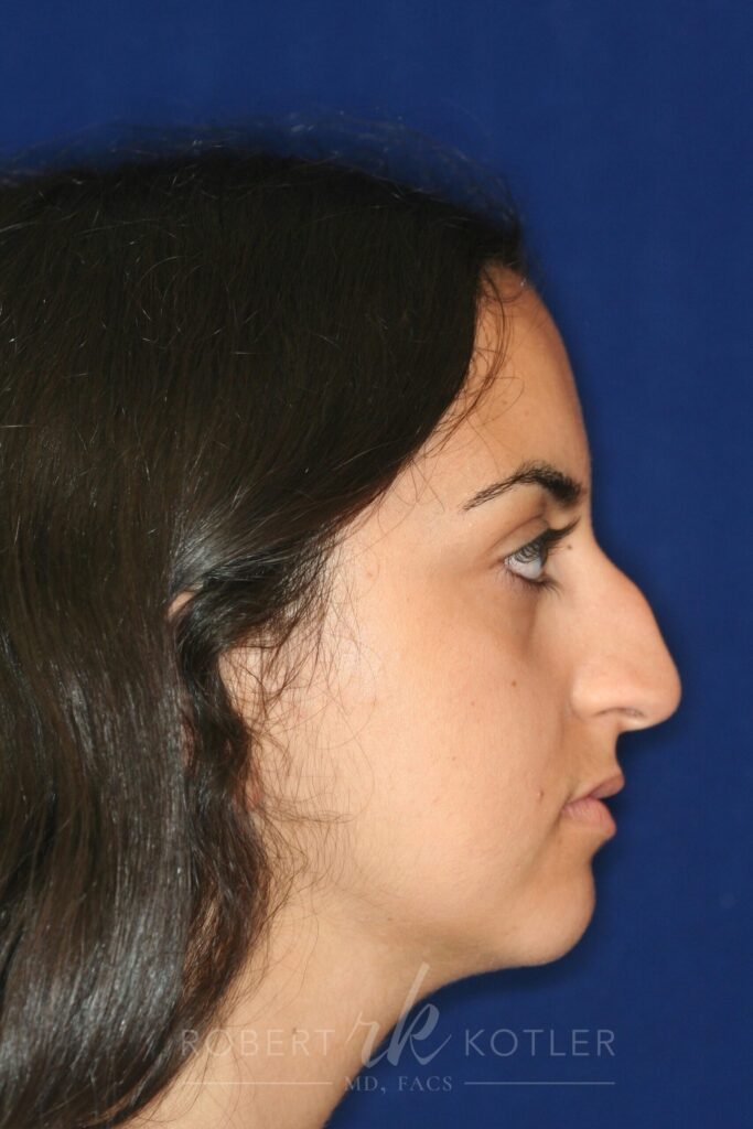 top rhinoplasty surgeons